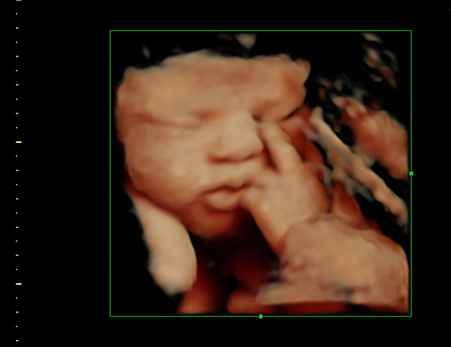3D ultrasound image at 33 weeks